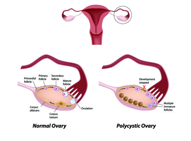 Polycystic Ovarian Syndrom