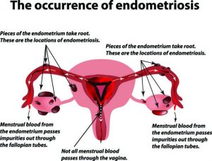 Nature of Endometriosis