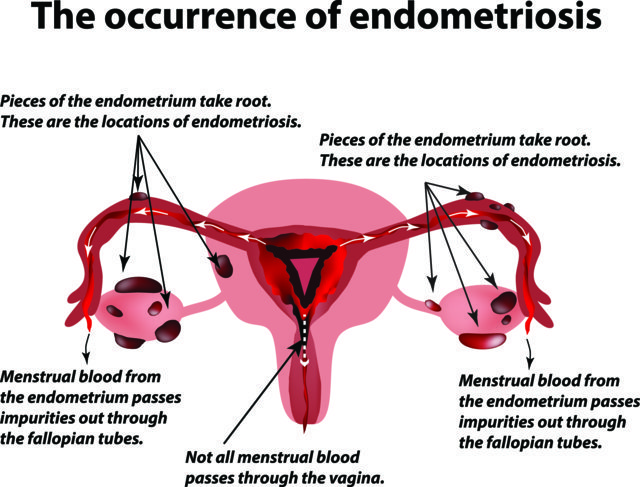 Endometriosis - Nevada Center for Reproductive Medicine